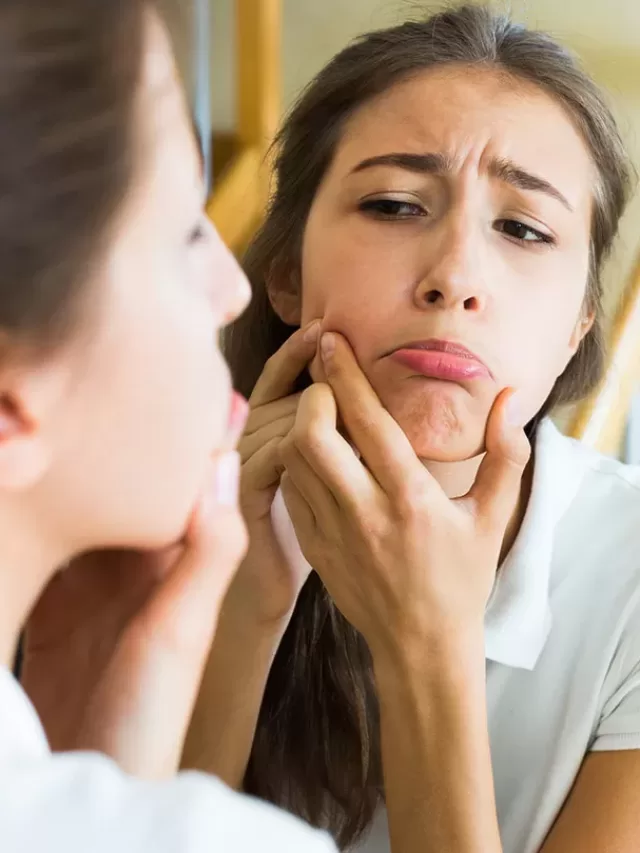 8 Powerful Home remedies for acne