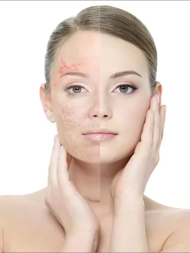 9 Best Treatments To Get Rid of Acne Scars