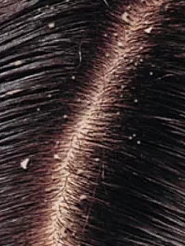 7 Effective ways to Get Rid Of Dandruff In Winter