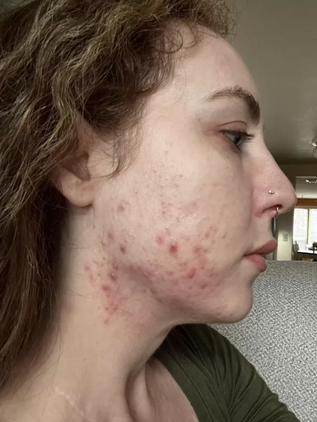 8 Tips to treat hormonal acne