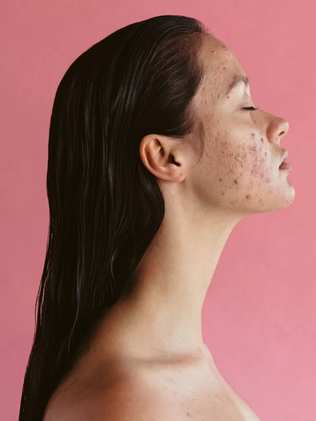 8 Surprising Causes of Adult Acne
